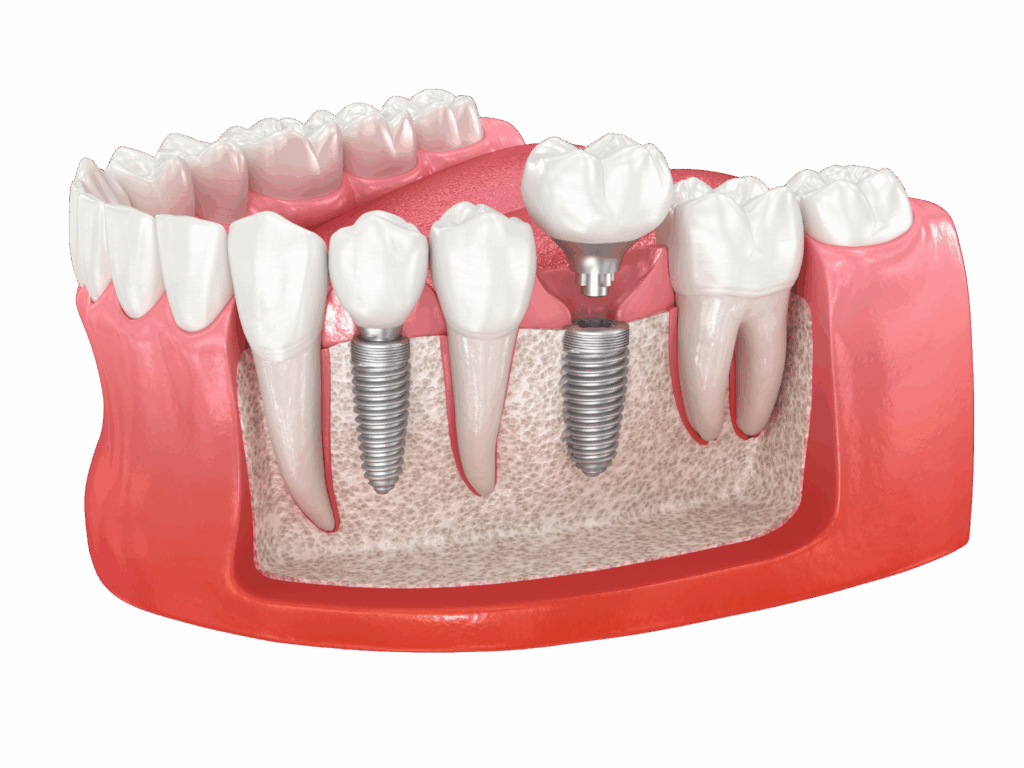 Quanto costano gli impianti dentali: guida completa per una scelta consapevole