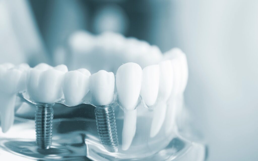 Denti fissi su impianti: quando sono indicati
