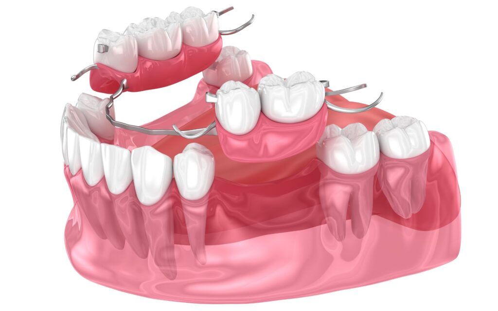 Protesi dentale mobile: quando viene scelta 