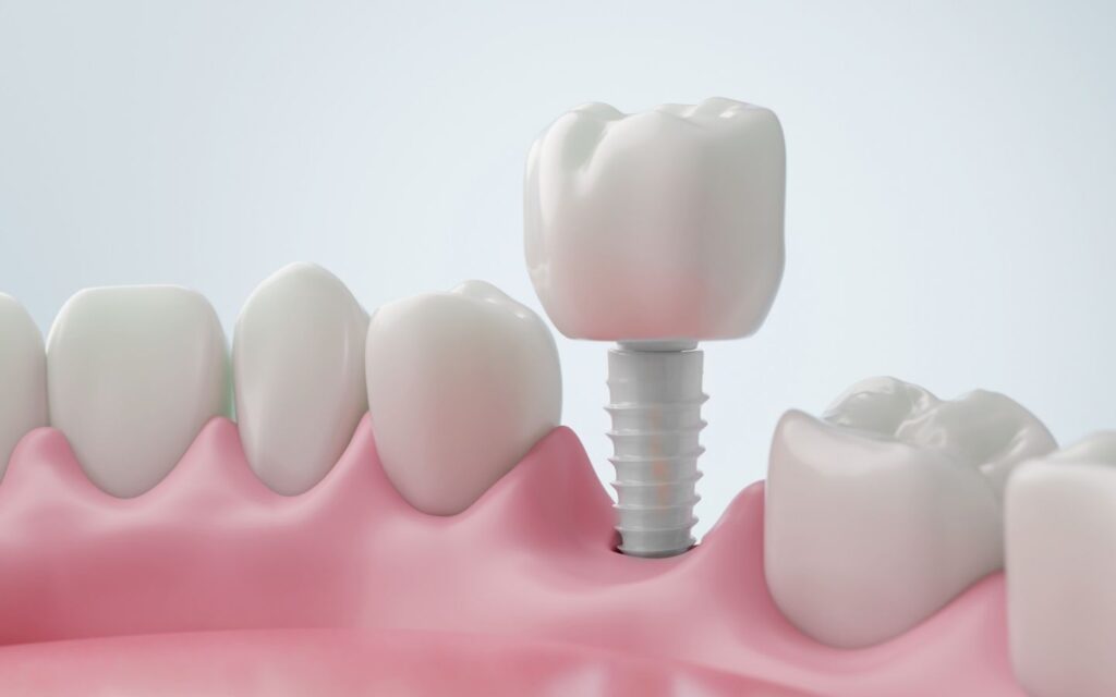 Impianti dentali con corone in ceramica o zirconio Resta In Italia