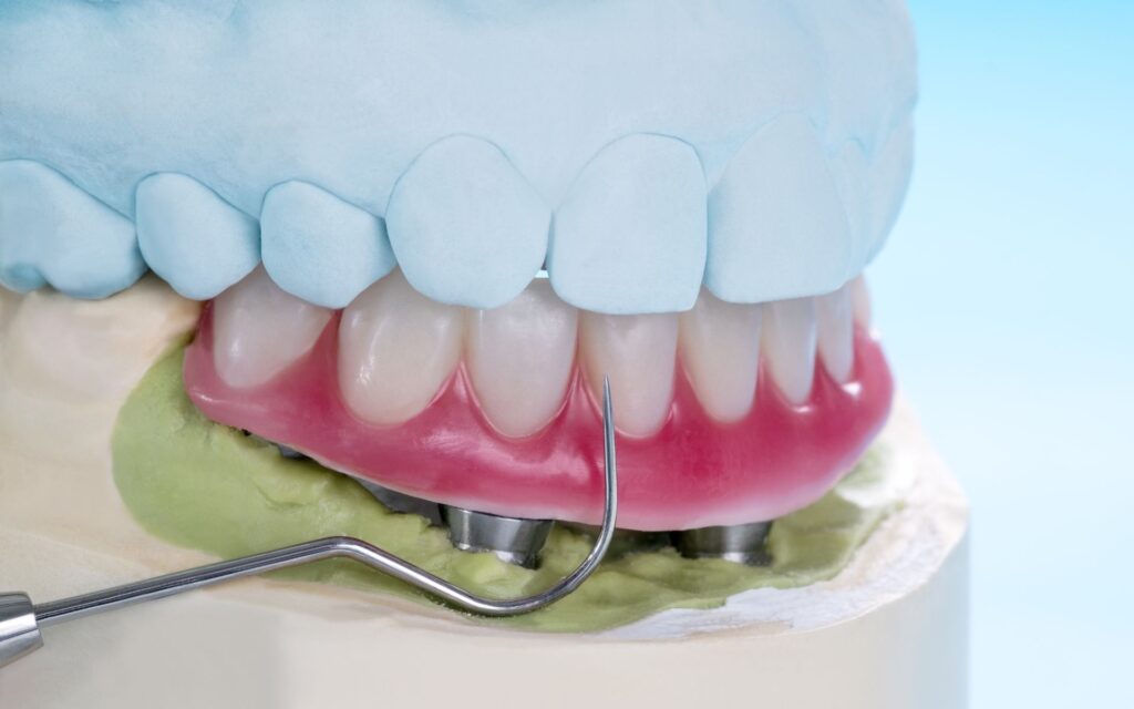 Overdenture su barra 4 impianti - Resta in Italia